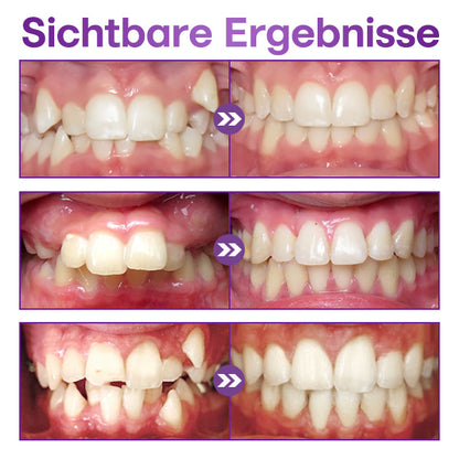 ToothClear Unsichtbare Zahnspange Set