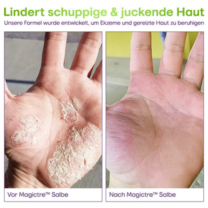 Magictre™ Ultimative Hautlösungs-Salbe